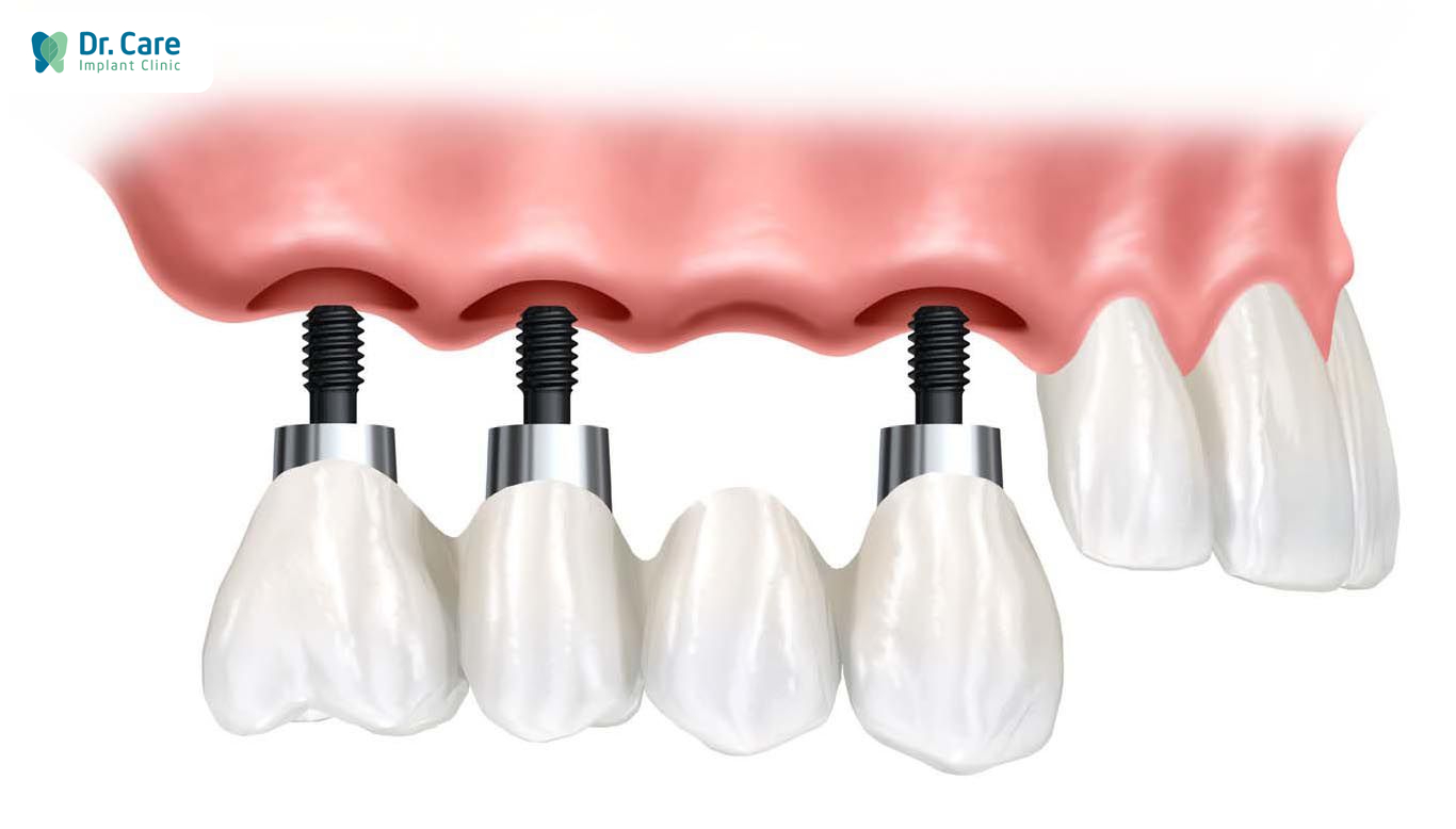 Vì sao mất 4 răng liên tiếp chỉ cần cấy 3 trụ Implant