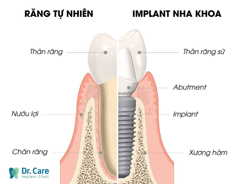 Vì sao nên trồng răng Implant ngay khi mất răng số 4?