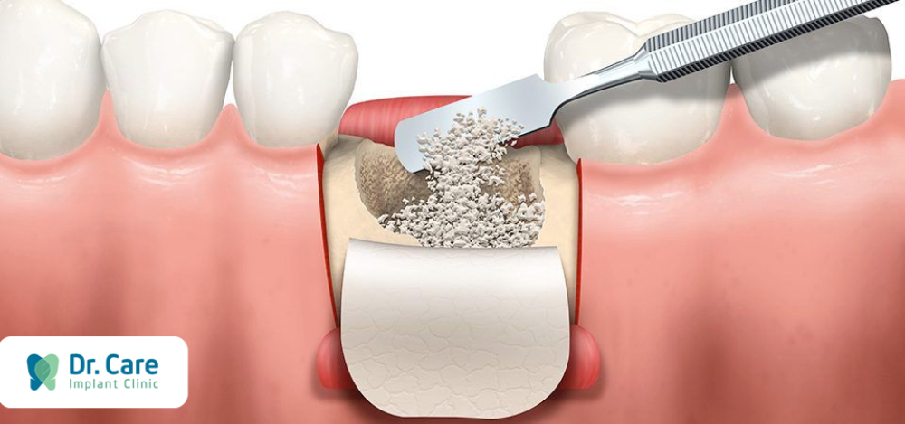 Các hình thức ghép xương do mất răng hàm dưới lâu năm