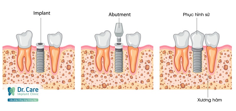 Trồng răng Implant khắc phục tình trạng hóp má do mất răng hàm