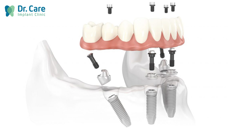 Răng Implant bắt vít là gì?