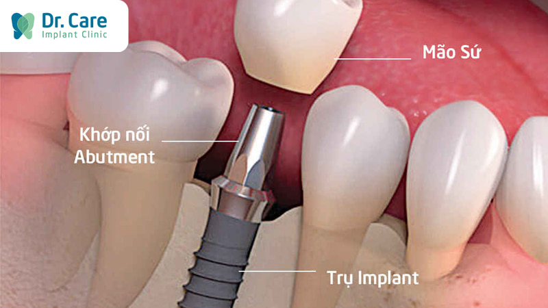 Răng Implant Ciment là gì?