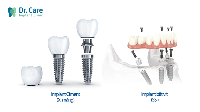 So sánh cấu tạo trụ Implant Ciment và Implant bắt vít 