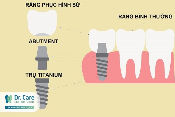 Mất răng số 3 có trồng răng Implant được không?