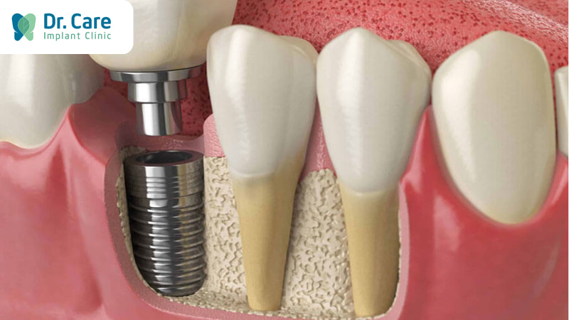 Ưu-Nhược điểm của trồng răng Implant Ciment