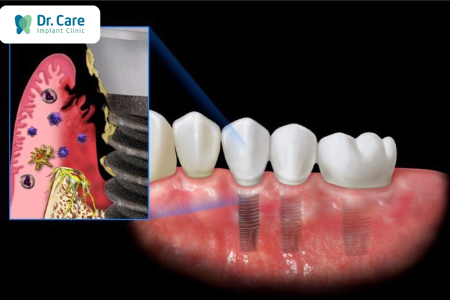 Hậu quả trồng răng Implant giá rẻ