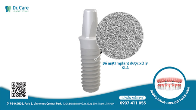Top 4 dòng trụ Implant Mỹ phổ biến hiện nay