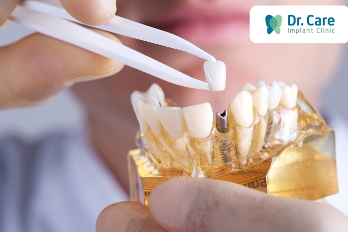 Trồng răng Implant là gì? Ưu nhược điểm của phương pháp cấy ghép Implant