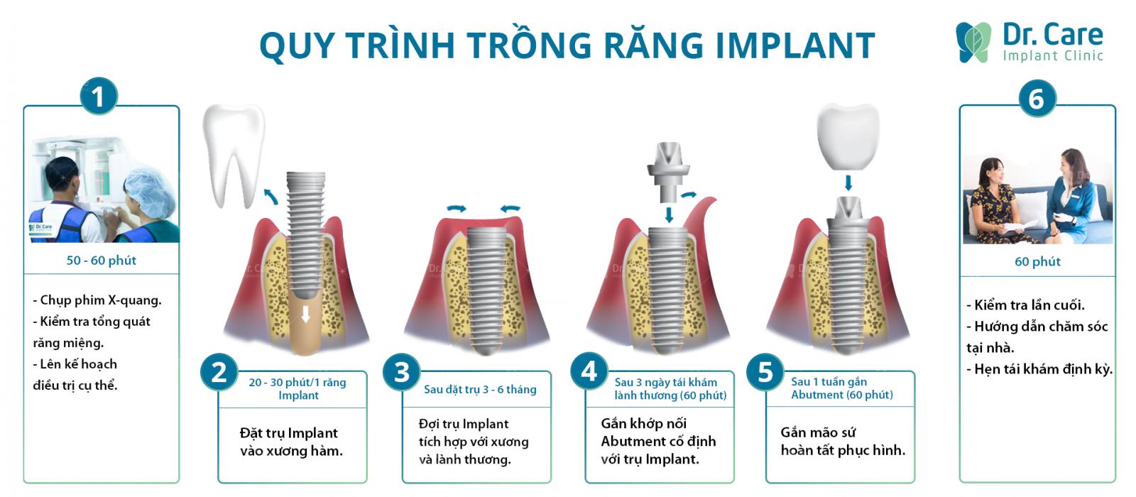 Quy trình trồng răng Implant chất lượng cao tại Nha khoa Dr. Care
