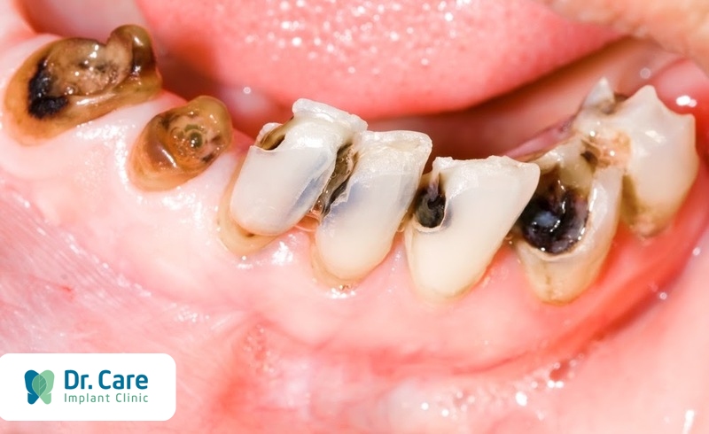 Nguyên nhân dẫn đến tình trạng sâu răng ở người lớn tuổi