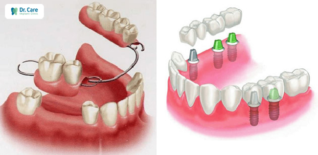 so sánh hàm giả tháo lắp và răng Implant