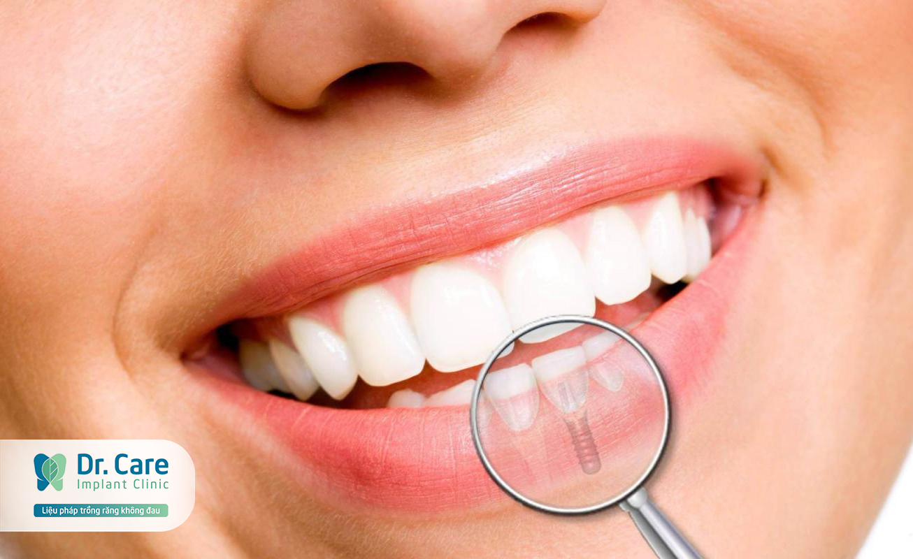 Quy trình phục hình mất răng còn chân răng