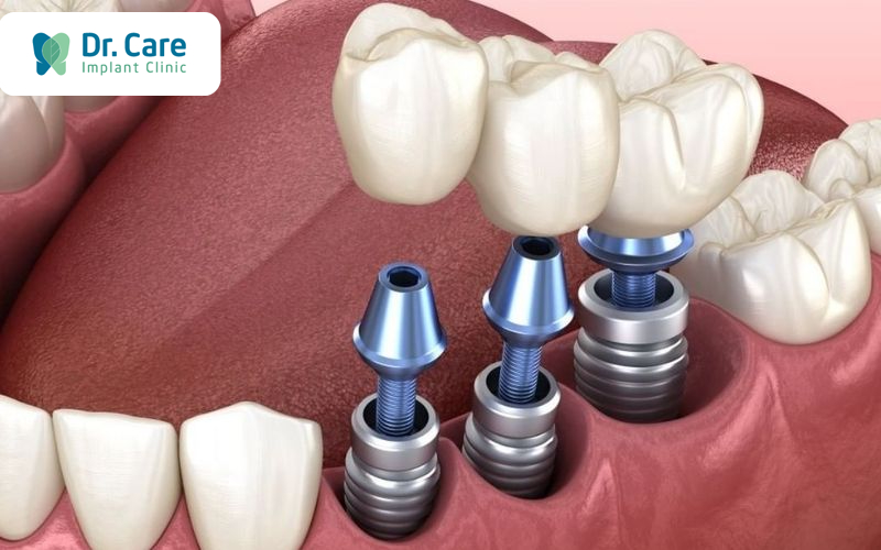 Trồng răng Implant khắc phục khuyết điểm của bọc răng sứ  