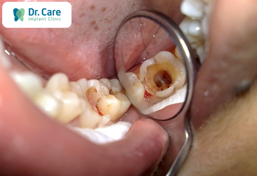 Những trường hợp mất răng chỉ còn chân răng phải trồng răng giả
