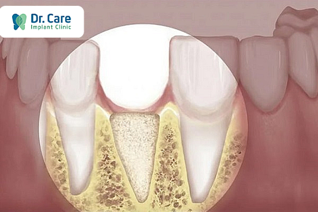 Những dạng tiêu xương hàm khi mất răng