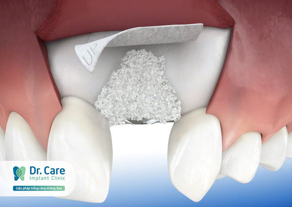 Tại sao cần ghép xương khi trồng răng Implant khắc phục tiêu xương hàm
