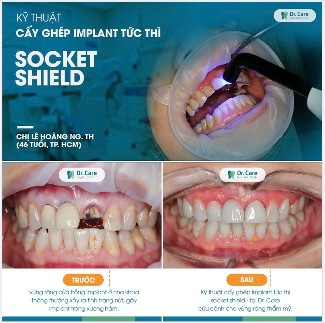 Kỹ thuật trồng Implant tức thì, phục hồi thẩm mỹ khi trồng Implant răng cửa