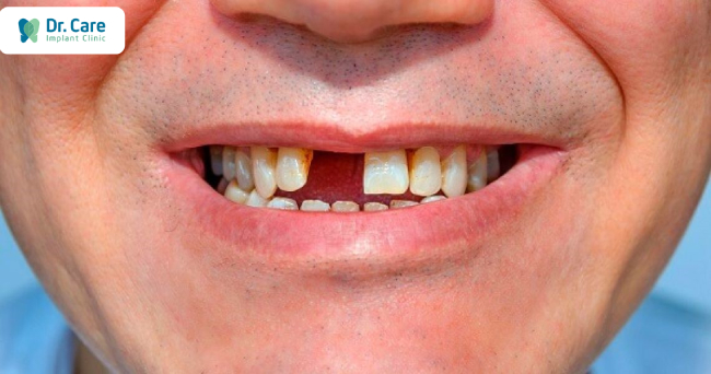 Mất răng cửa ảnh hưởng thế nào đến sức khỏe răng miệng?