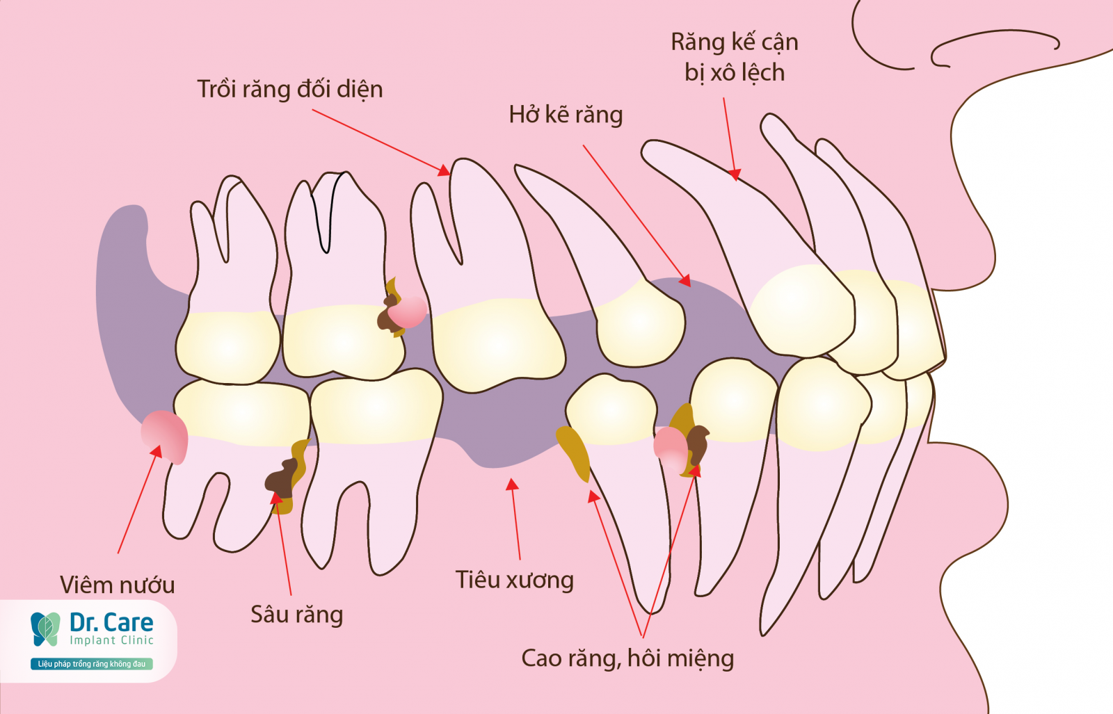 Tác hại của tình trạng mất răng vĩnh viễn
