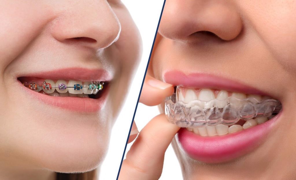 2 Phương pháp niềng răng khi mất răng