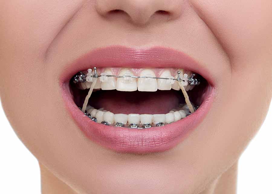Có thể kéo răng thay thế răng mất nhờ niềng răng được không?
