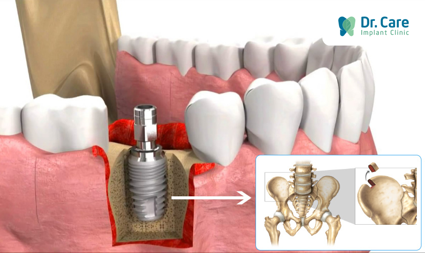 Các dạng ghép xương điều trị tiêu xương răng cơ bản hiện nay