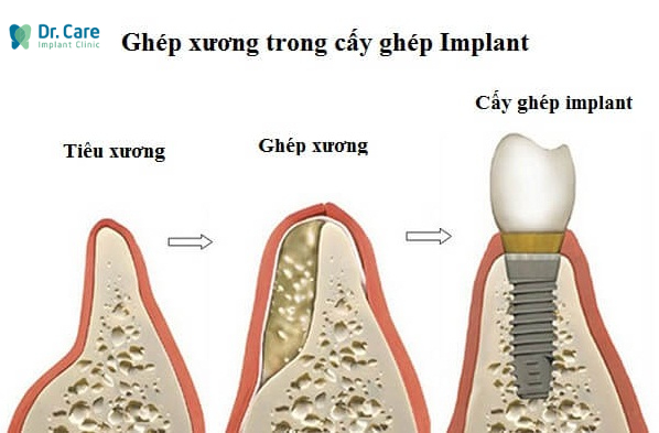 Tại sao tiêu xương răng phải ghép xương mới trồng được răng Implant?