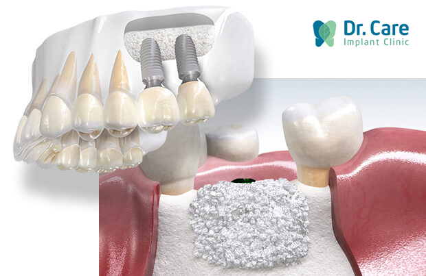 Trồng răng Implant điều trị tiêu xương ổ răng 