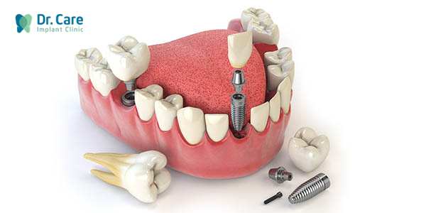 Giải pháp phòng tránh tiêu xương răng hiệu quả