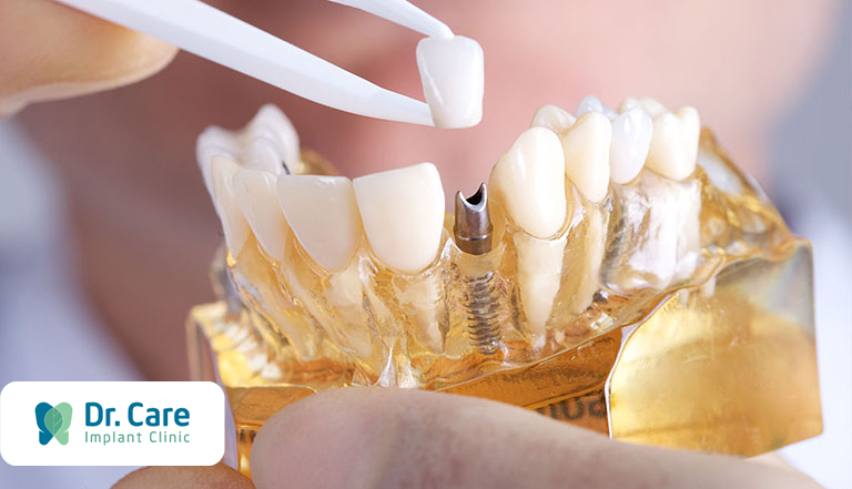 Phục hình răng sứ trên Implant là gì?