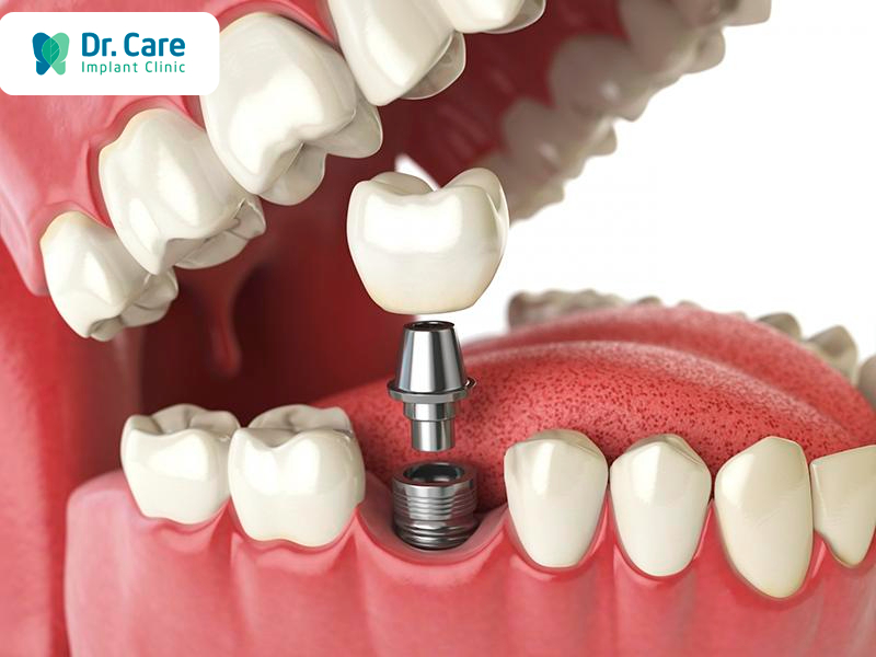 Phục hình răng sứ trên Implant có an toàn không?