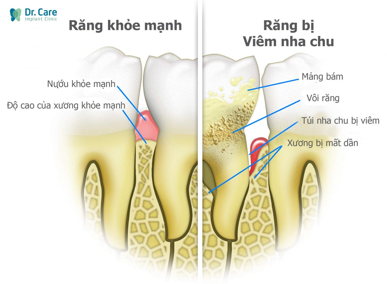 Nguyên nhân gây tiêu xương răng phổ biến