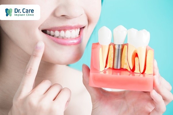Trồng 1 cái răng giá bao nhiêu tiền bằng cấy ghép Implant (trồng răng Implant)?