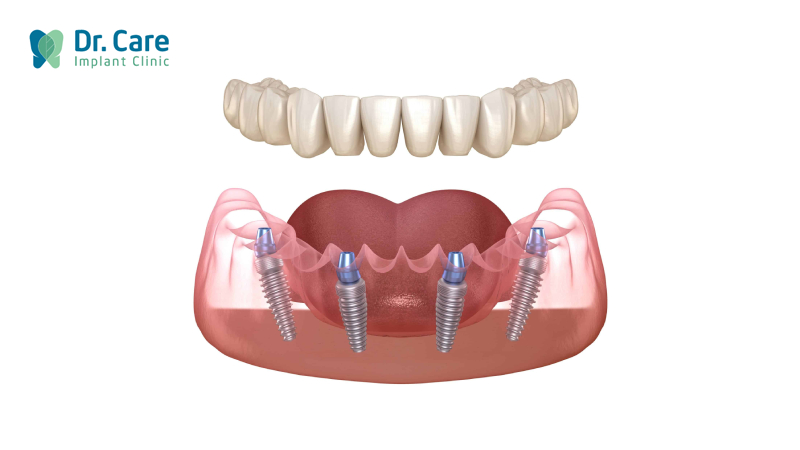 Trồng răng Implant toàn hàm All On 4 là gì?