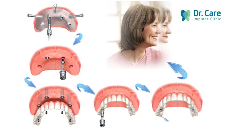 Trồng răng Implant toàn hàm All On 4 là gì?