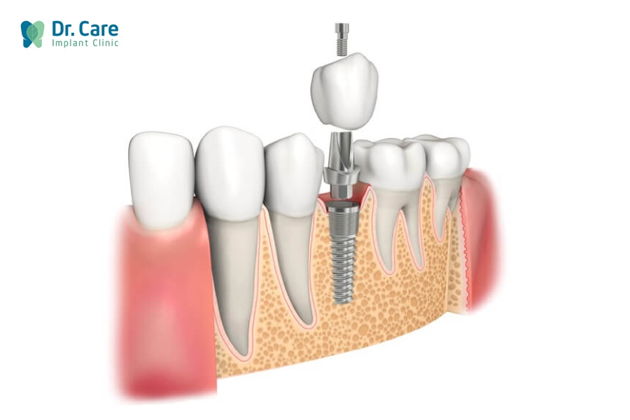 Viêm nha chu - mất răng có cấy ghép Implant được không?
