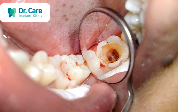 Mục chân răng là gì? Nguyên nhân chân răng bị mục