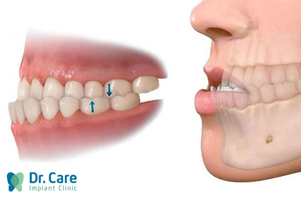 Răng móm là gì? Nguyên nhân gây răng móm
