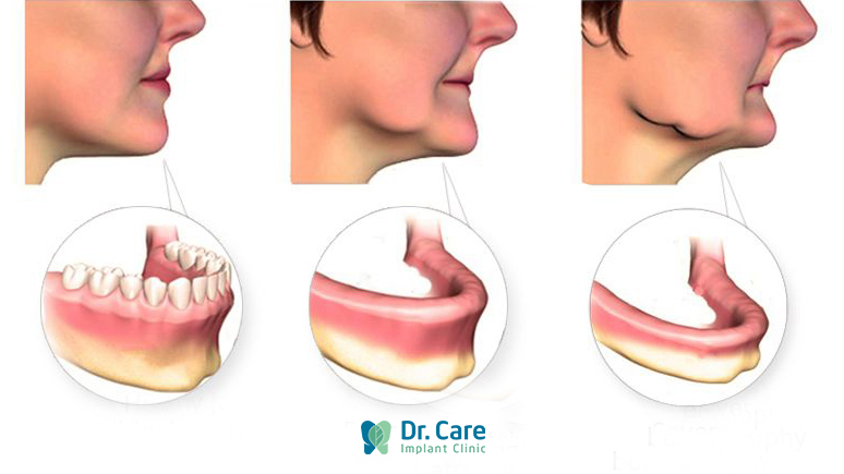 Vì sao mất răng dẫn đến tình trạng bị móm?