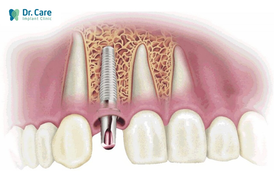 Vì sao mất răng do chân răng bị mục nên trồng răng Implant?