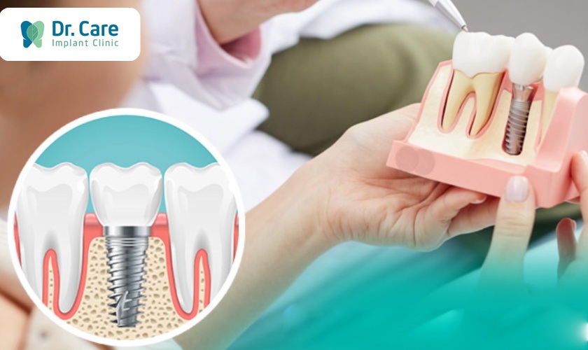 Nên lựa chọn trồng răng Implant trả góp hay trồng răng Implant giá rẻ?