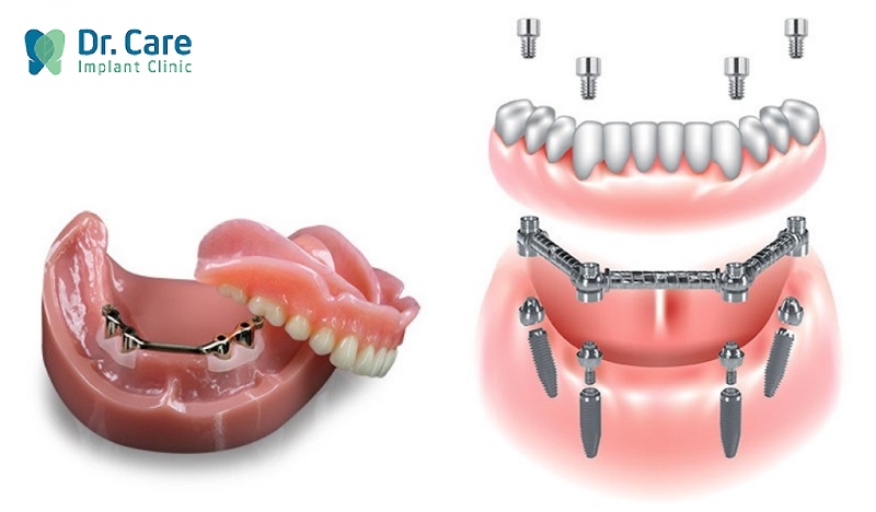 Phục hình răng tháo lắp với hàm khung CAD/CAM trên Implant
