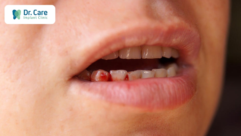  Dấu hiệu sưng nướu răng có mủ giai đoạn nặng