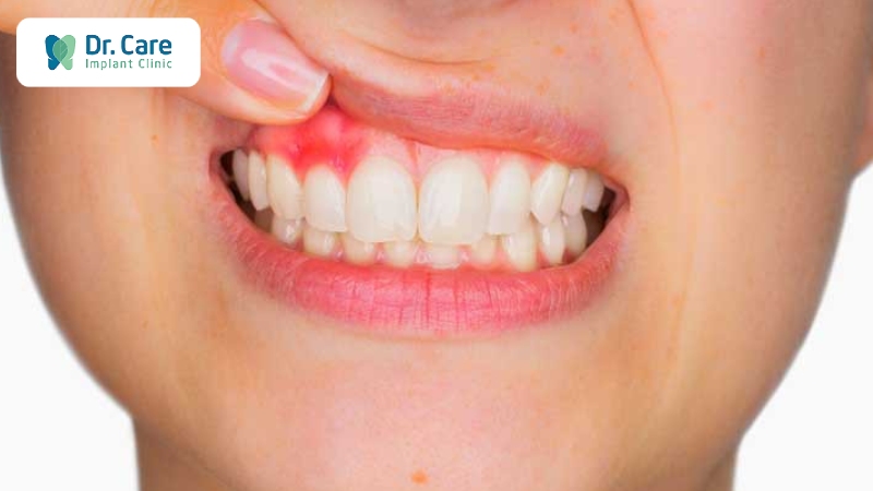 Dấu hiệu sưng nướu răng có mủ giai đoạn đầu