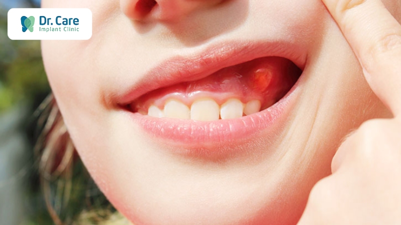 Sưng nướu răng có mủ là bệnh gì? 