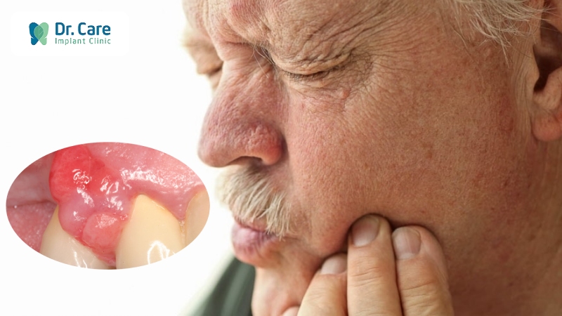 Bệnh sưng nướu răng có mủ nguy hiểm không?