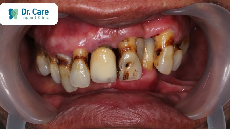 Viêm nha chu - Nguyên nhân hàng đầu gây mất răng toàn hàm