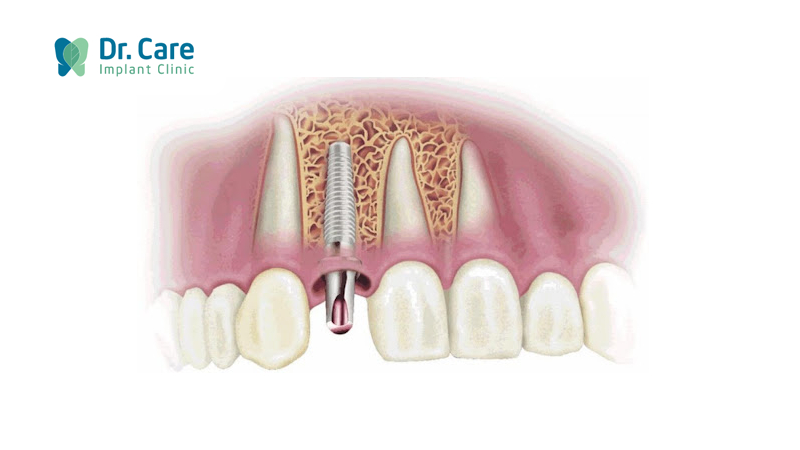 Bệnh loãng xương có thể trồng răng Implant không?
