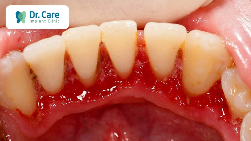 Viêm lợi do răng sứ đâm sâu vào nướu