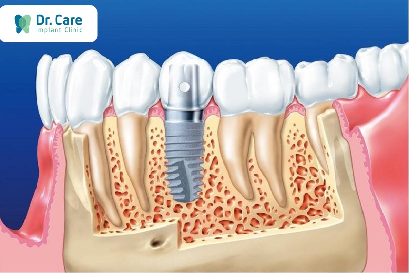 Bệnh loãng xương - mất răng có trồng răng Implant không?